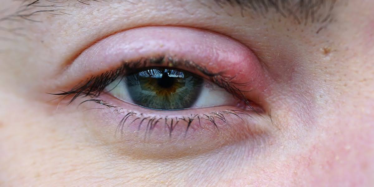 How To Get Rid Of A Stye