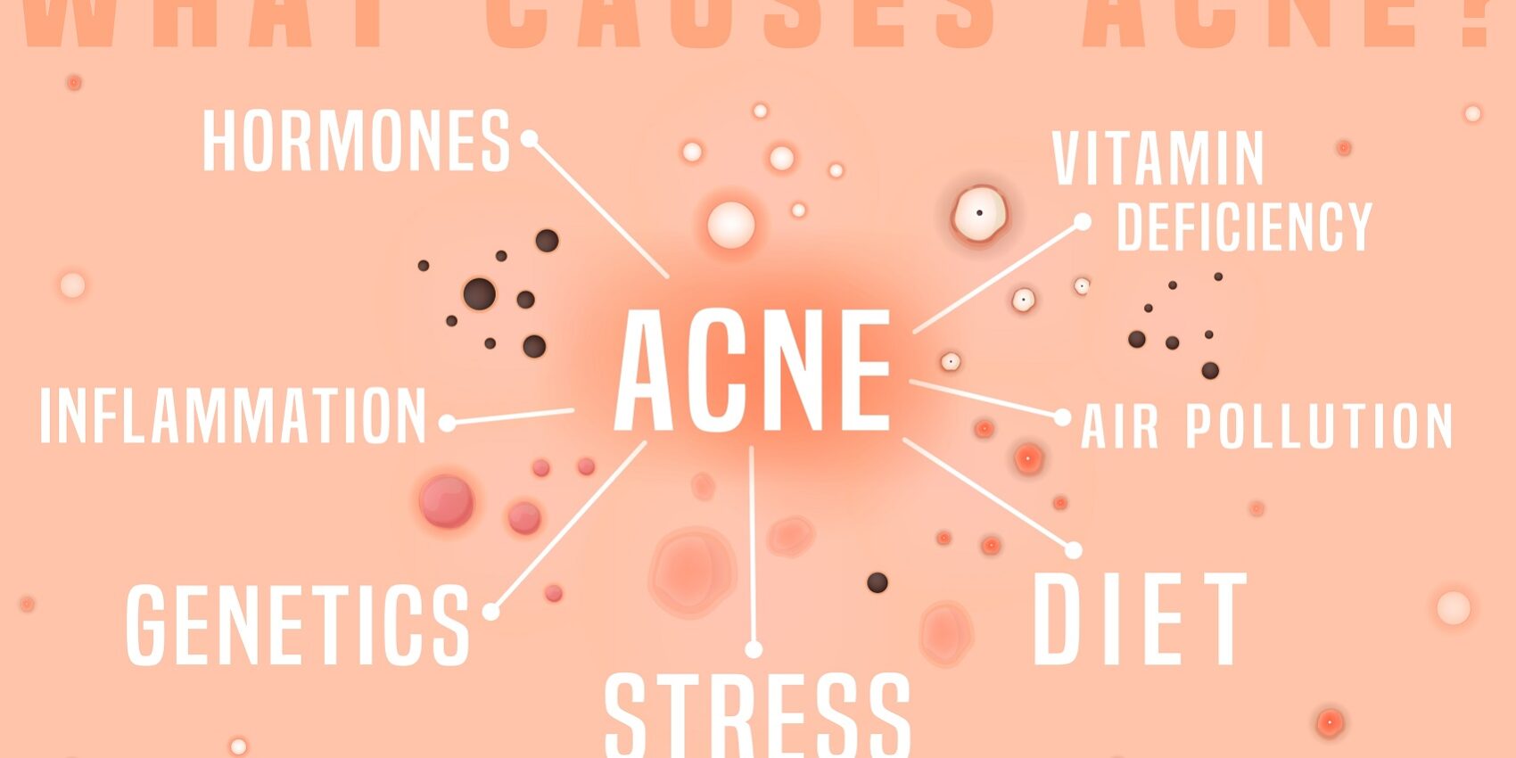 causes of acne