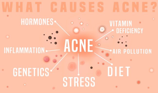 What,Causes,Acne,sugar,diet causes of acne