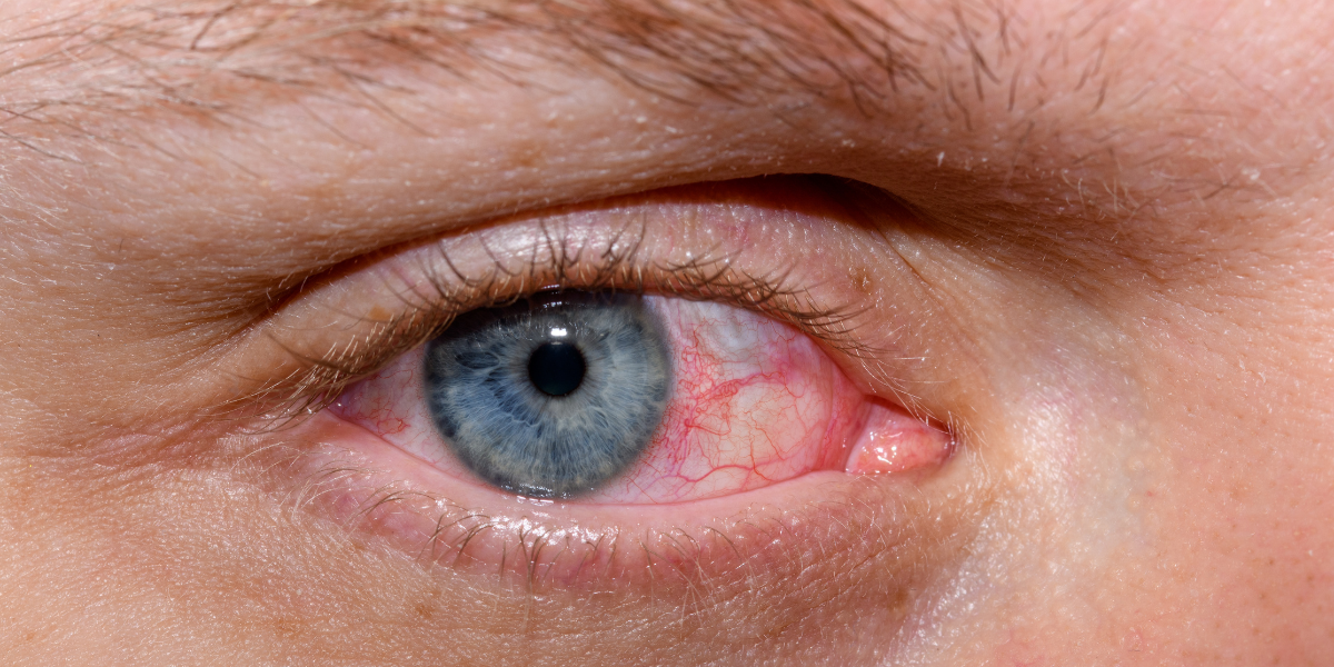 When And How To Use Heated Eye Masks For Dry Eyes When And How To Use Heated Eye Masks For Dry Eyes